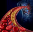 Reishi a rozvoj aterosklerózy